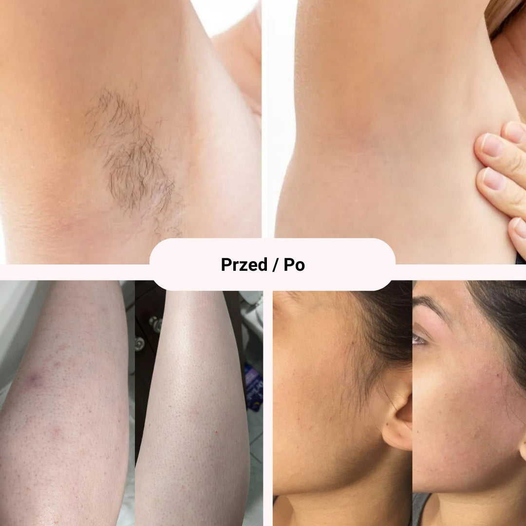 Removely IPL 3+ (Try & Buy - Poland)