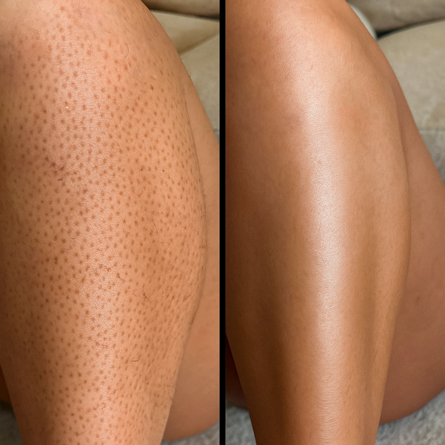 Removely Peel Shot bundle