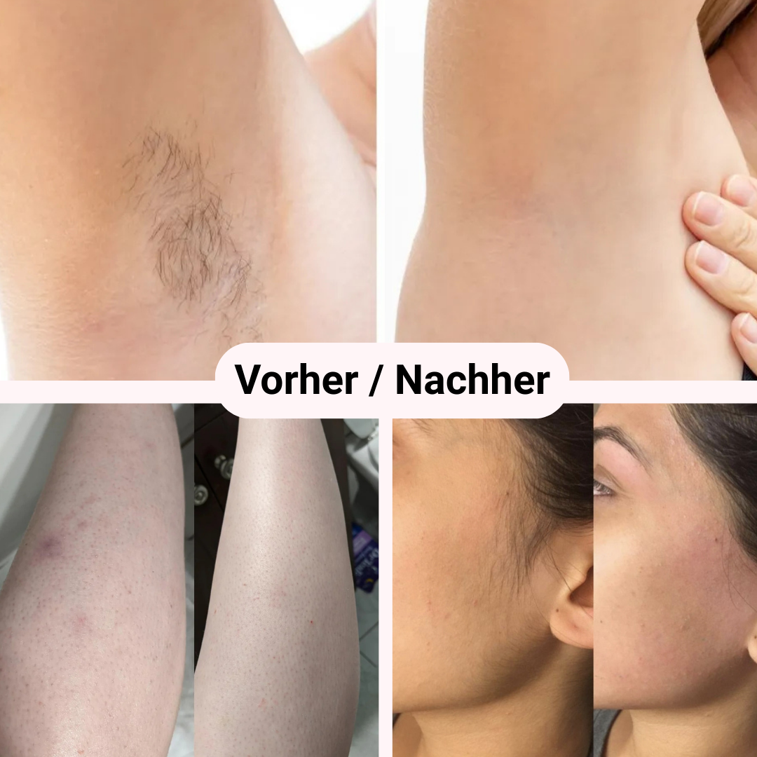 Try & Buy Aktion - Removely IPL 5+